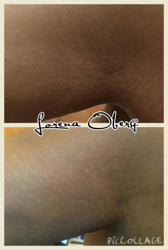 stretch marks dark