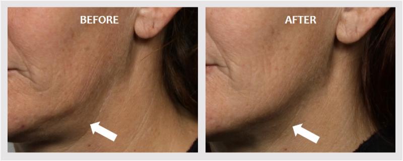 March Specials NEW Microcurrent Facial 20 Allergan Coupon Instagram
