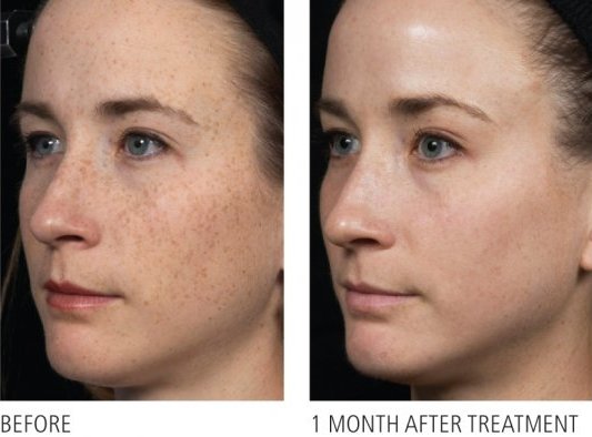 brown spot