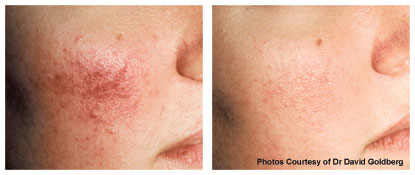 rosacea