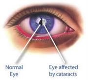 Picture of a normal eye vs. an eye affected by cataracts