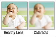 Clear and blurry picture of baby, as if with a healthy lens or with cataracts