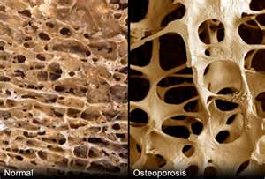 Porous Bones