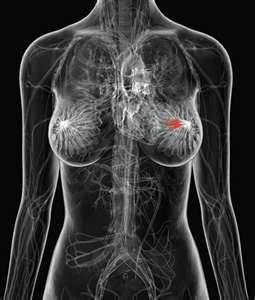Breast cancer