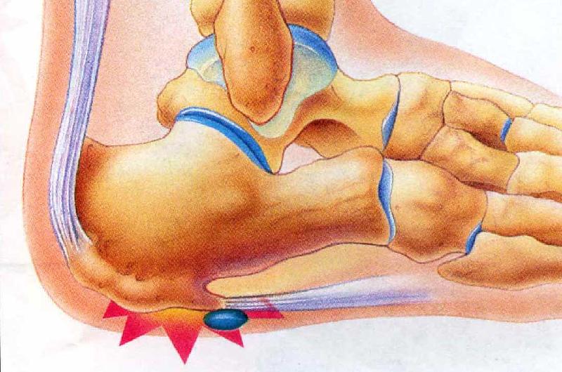 HeelSpur