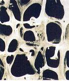 Close-up of porotic bone 